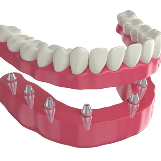illustration of full implant dentures in eugene or