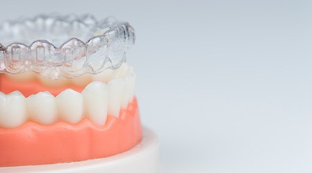 Invisalign aligner being placed on model of teeth