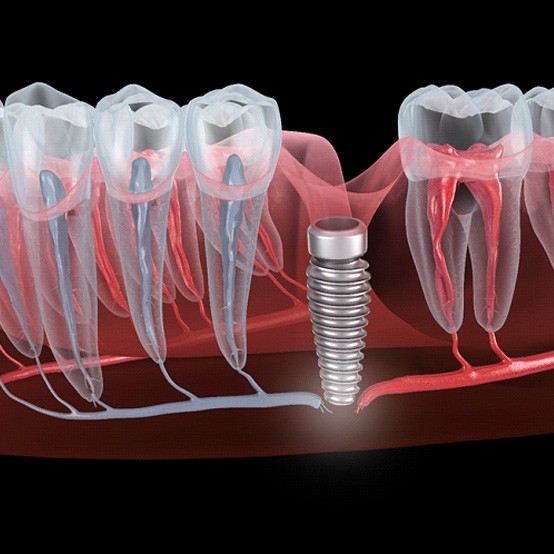 Illustration of a failed dental implant in Eugene, OR