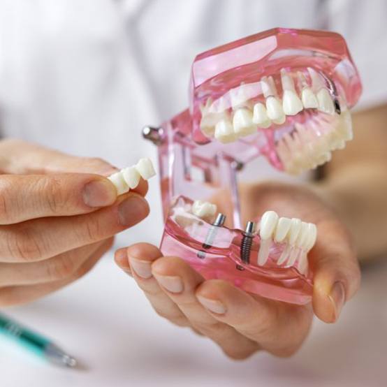 a dentist holding a model of a dental implant bridge